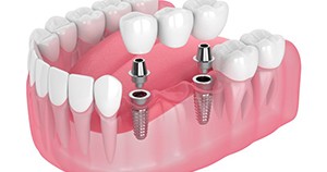 Illustration of dental implant bridge